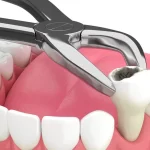 What You Should Know About Dental Extraction