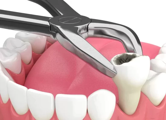 What You Should Know About Dental Extraction