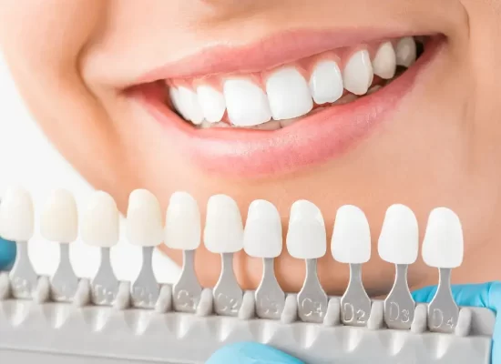 Teeth Whitening – Pros Cons and Alternatives