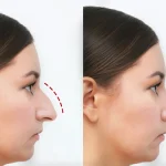 The Role of Rhinoplasty in Enhancing Facial Aesthetics
